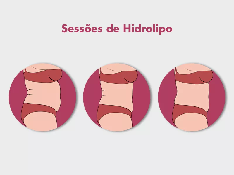 Tratamento com Hidrolipo não aspirativa